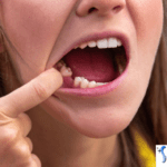 How Long Do Gums Stay Swollen After a Tooth Extraction?