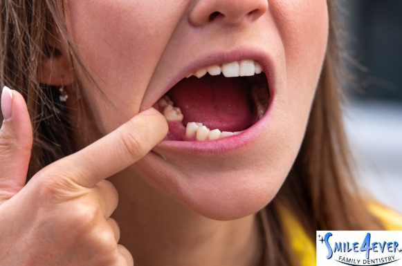 How Long Do Gums Stay Swollen After a Tooth Extraction?